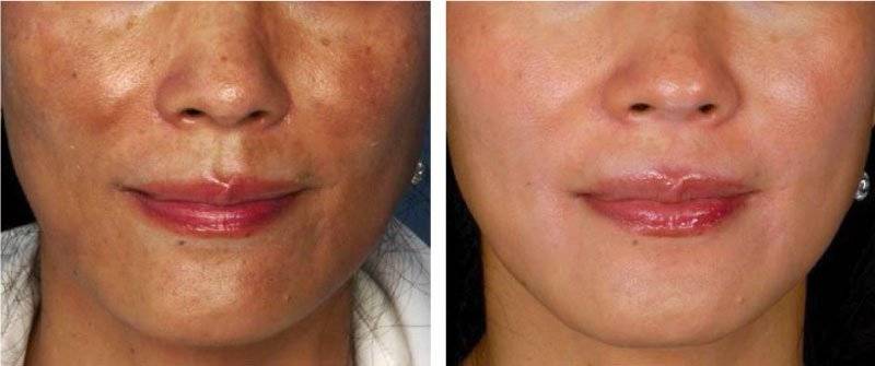 Dr. Melinda Silva MD - ZO Peel