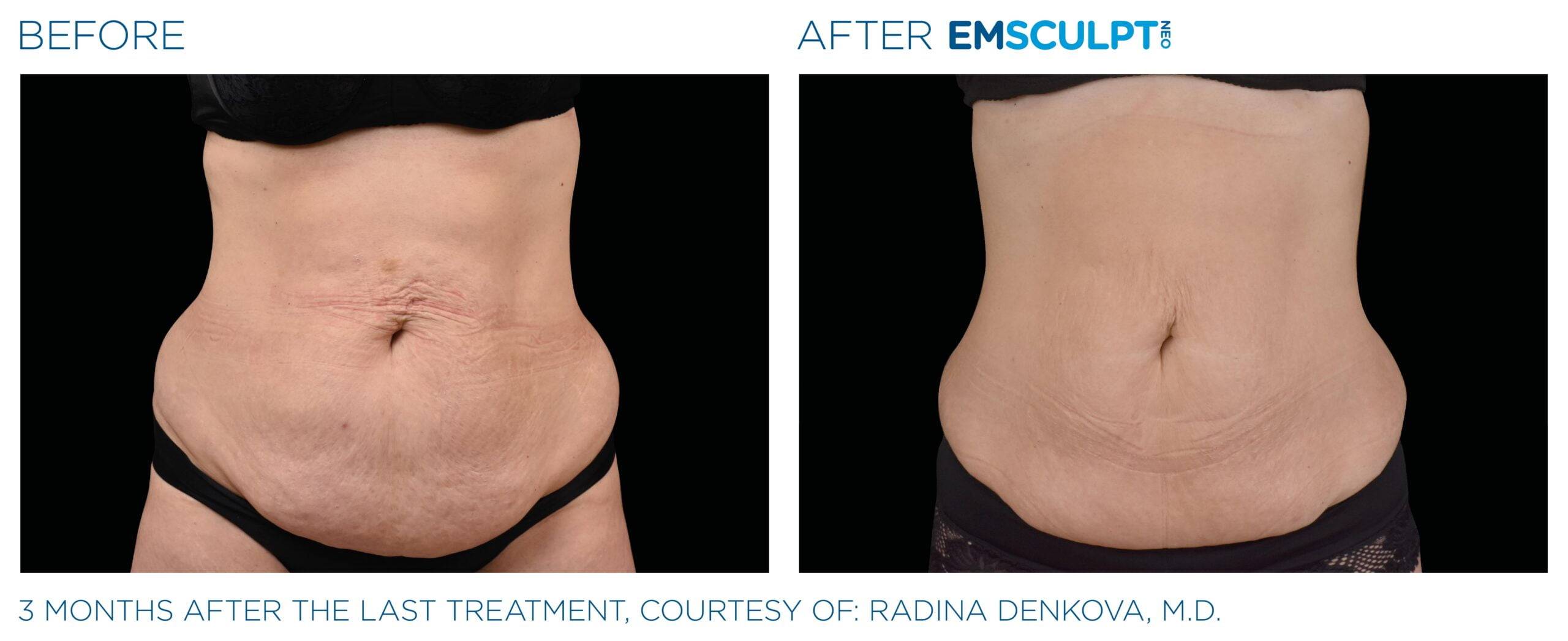 Dr. Melinda Silva MD - Result Using Emsculpt Stomach Front Image