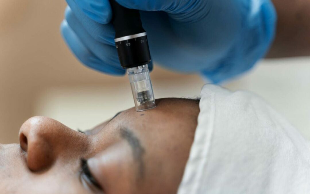 microneedling treatment