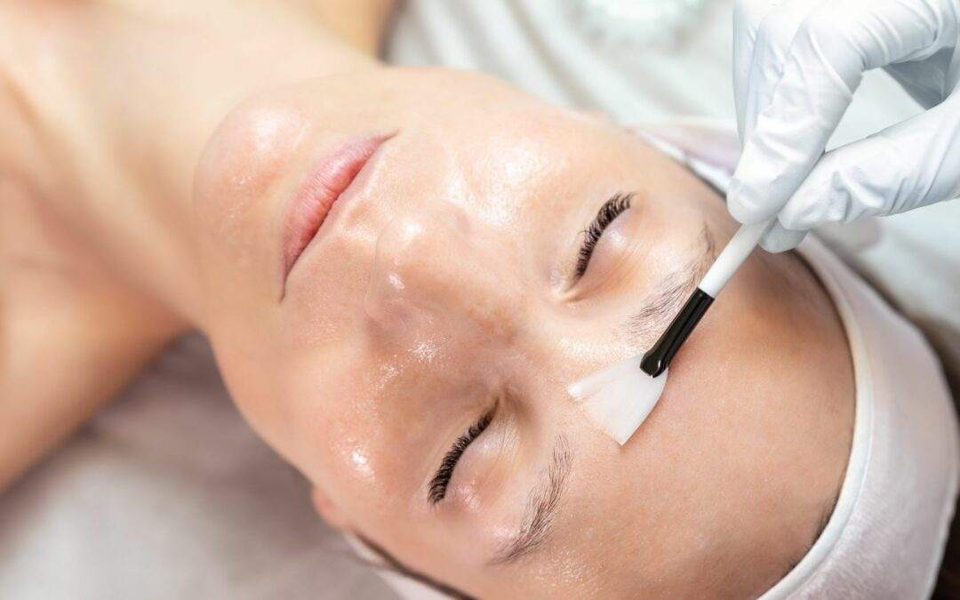 chemical peel