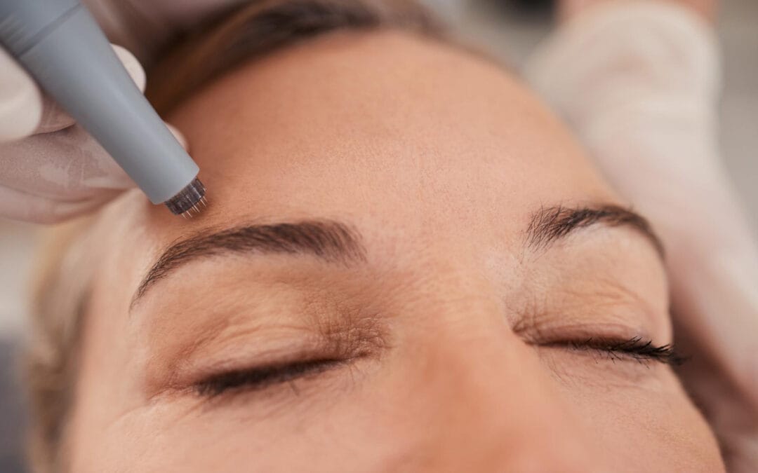 microneedling treatment