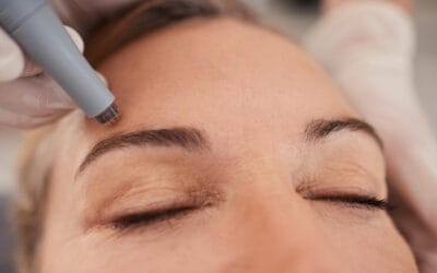 Revitalize Your Complexion with Microneedling Skin Rejuvenation